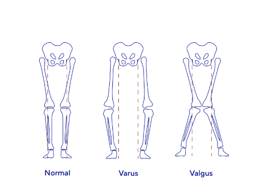 Abnormal alignment of the legs 
