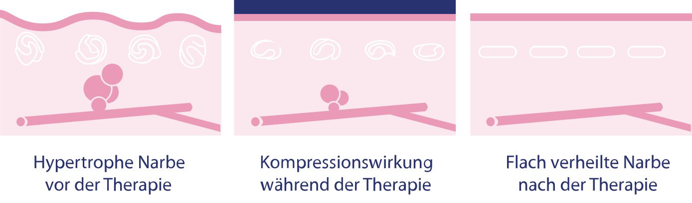 Illustration zur Nachsorge und Lebensqualität nach einer Brustkrebsoperation