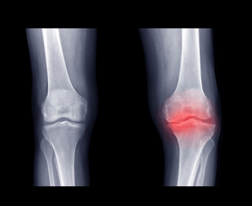 knee x rays osteoarthritis