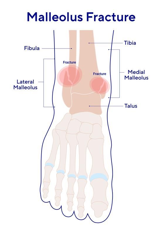 B2C - 2026 - IMG - EN - ORT - FRA - PAT - SYM - Malleolus fracture.jpg