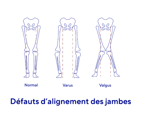 Arthrose et défauts d’alignement des jambes
