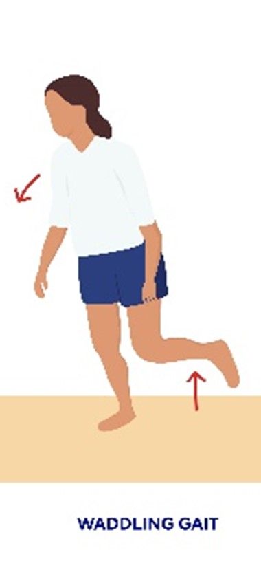 Abnormal gait cycle 3