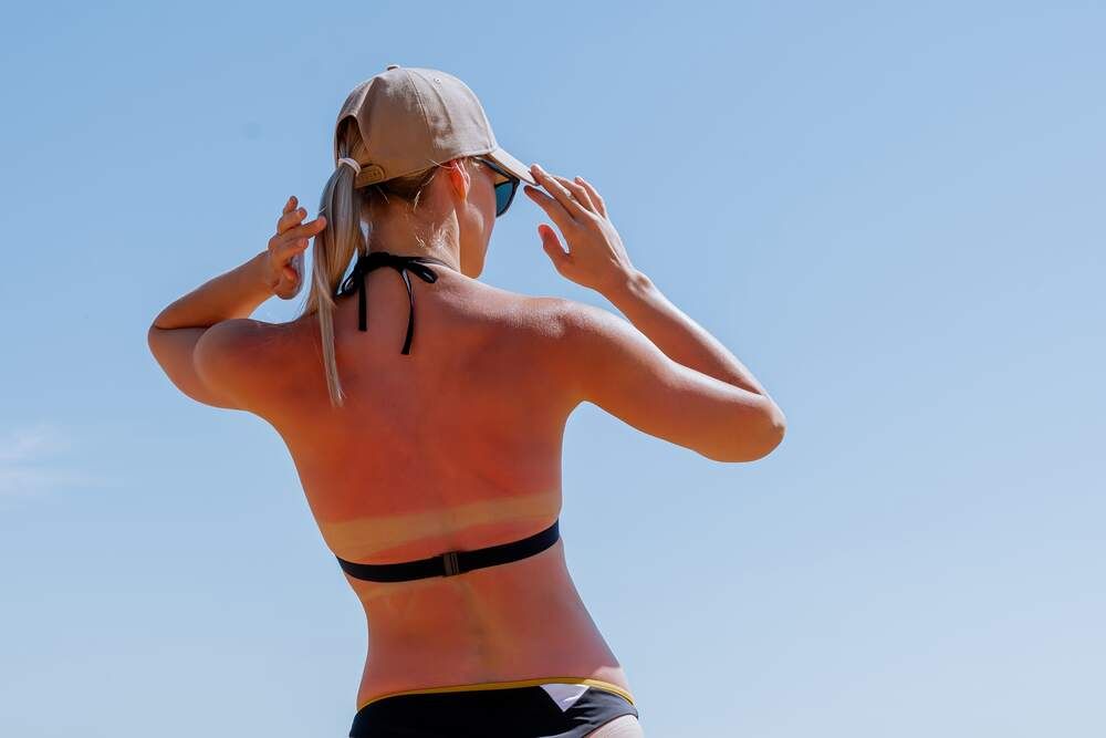 Sunburn and risks related to prolonged sun exposure1.jpg