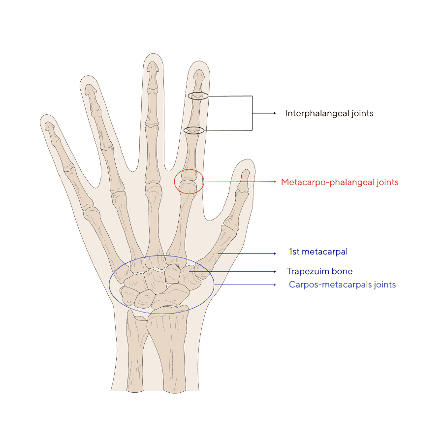 Scheme thumb osteoarthritis