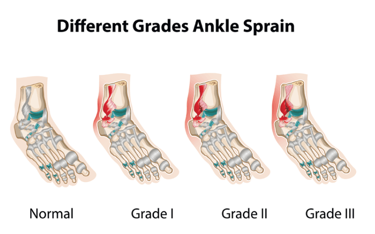 Different grades ankle sprain