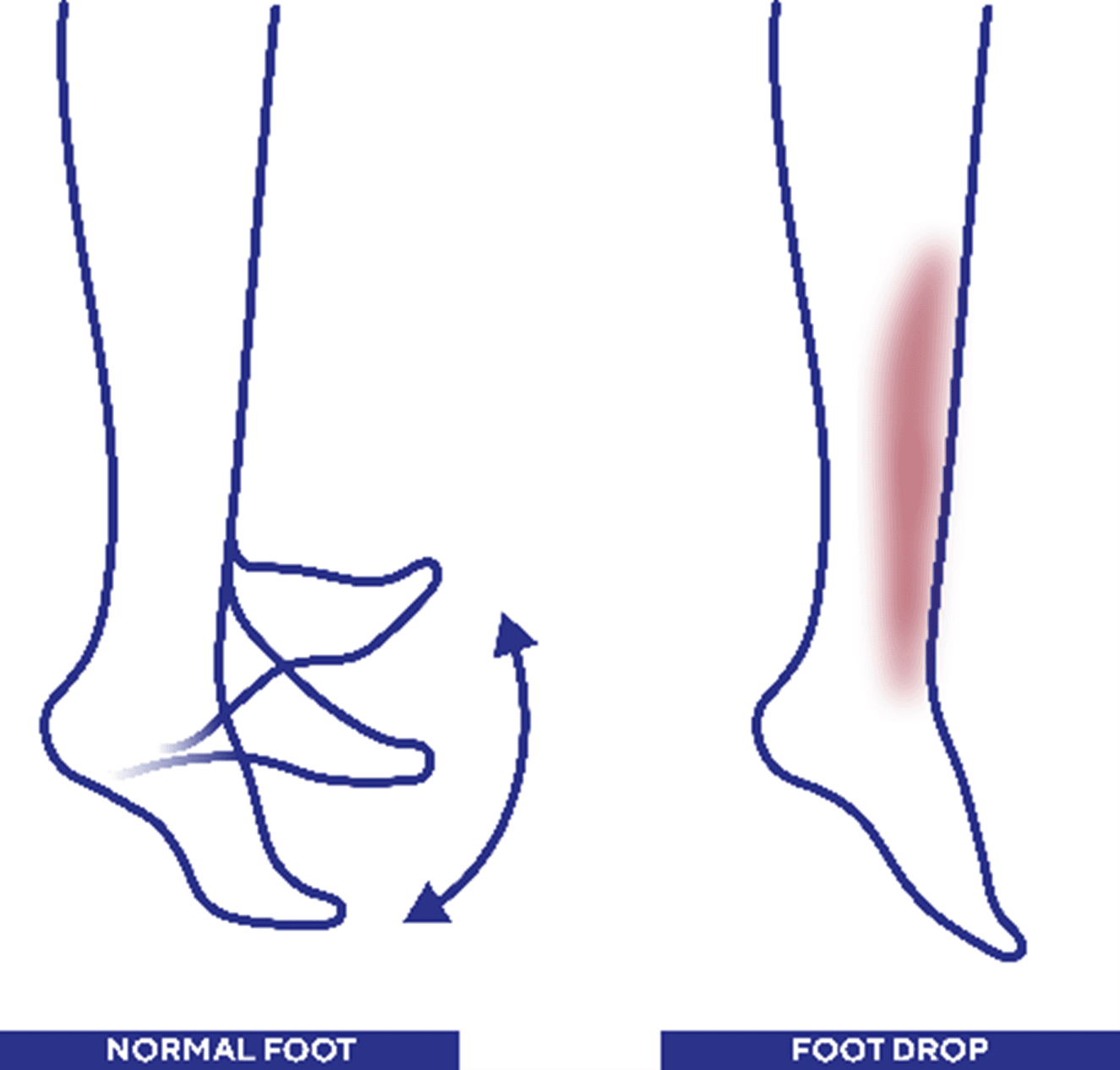Foot drop syndrome