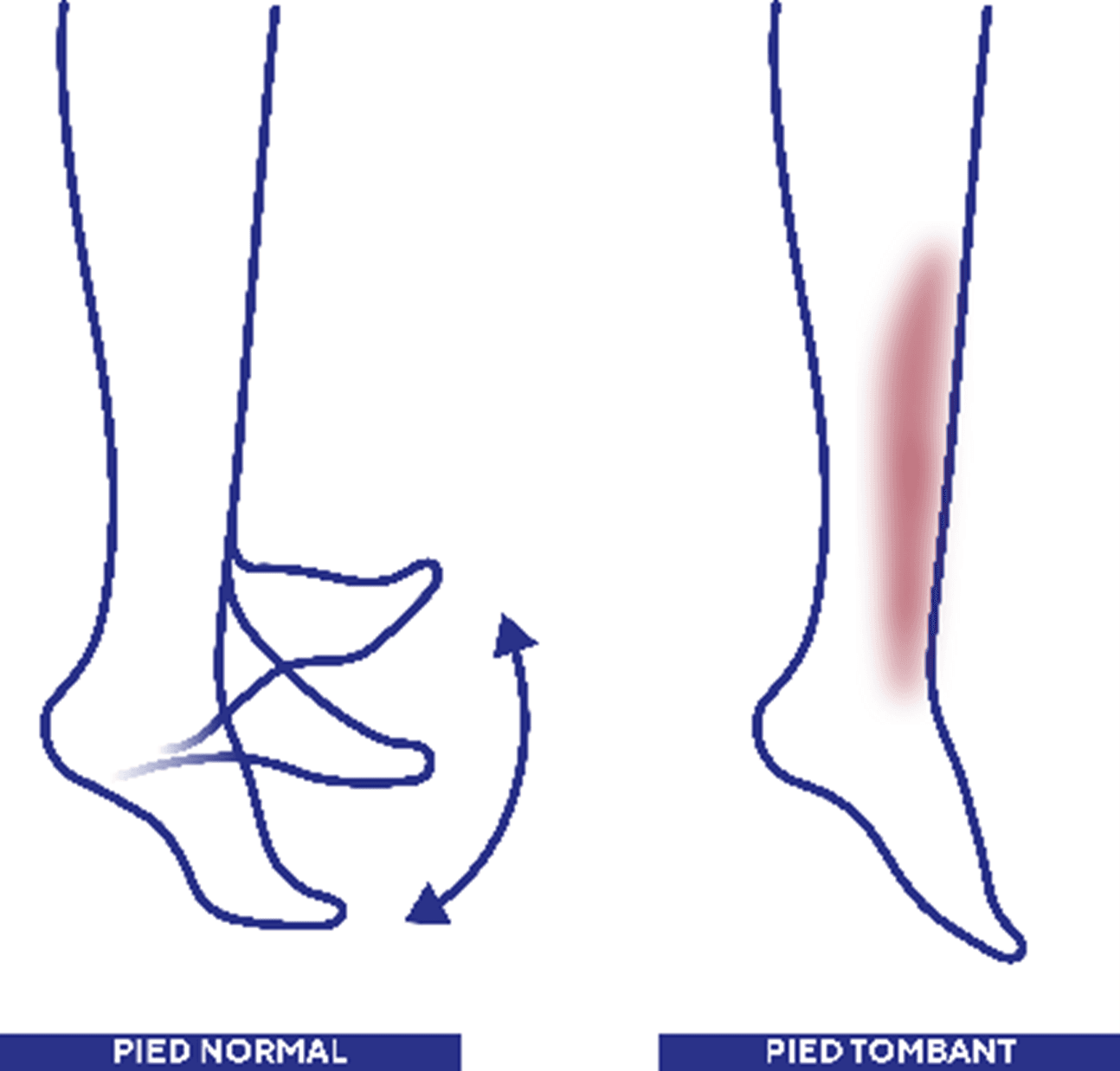 Tout savoir sur le pied tombant