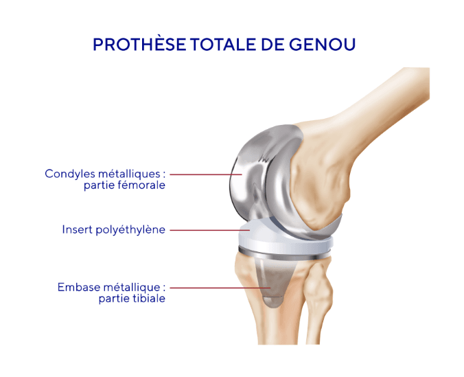 prothèse totale du genou ou PTG