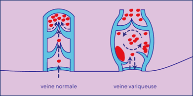 schema veine variqueuse.png