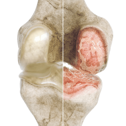 synovial-effusion-of-the-knee.png