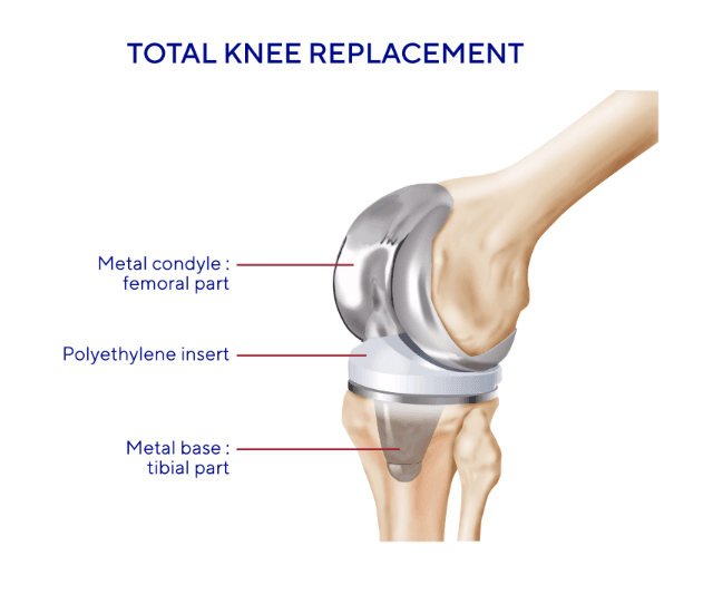how does total knee replacement work